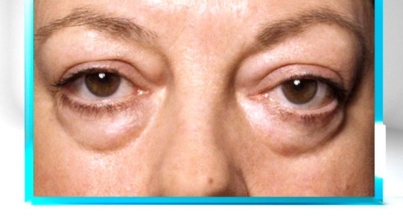 Мешки под глазами